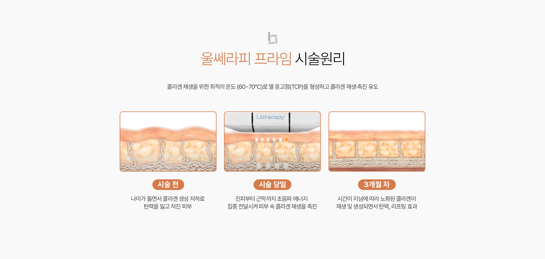울쎄라피 시술원리