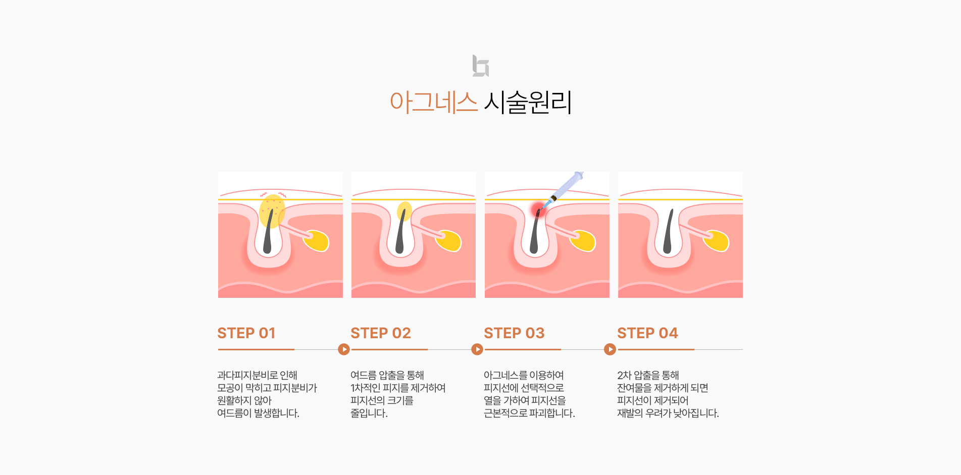 아그네스 시술원리